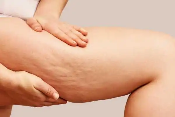 Image of woman showing leg with cellulite Seacombe