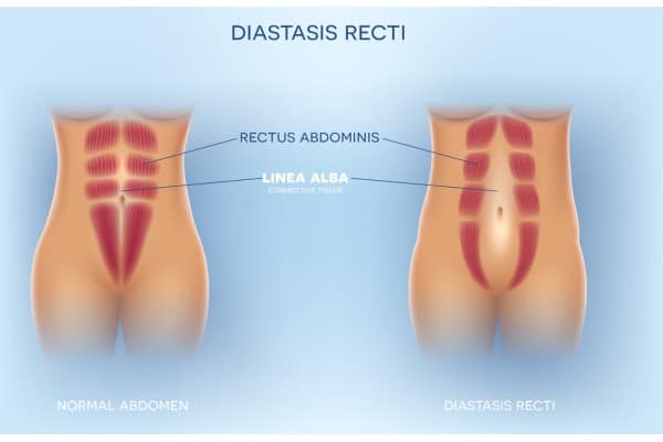What Non-Surgical Options Are Available for Diastasis Recti Seacombe?
