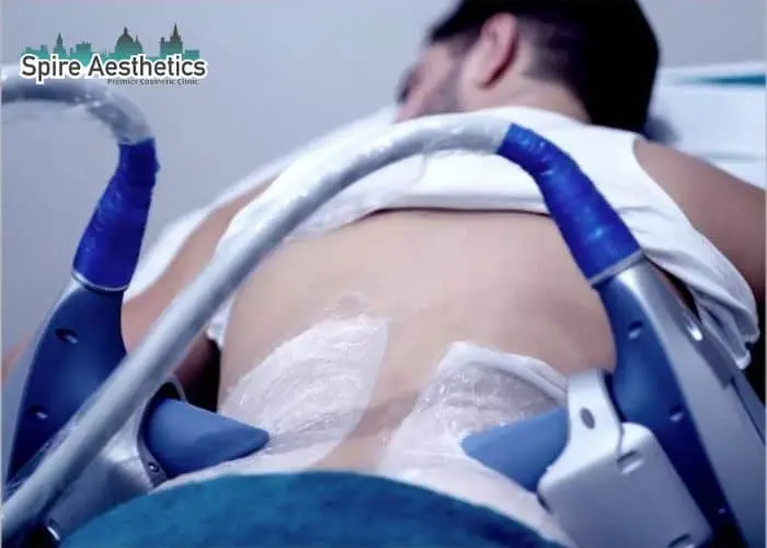Man having fat freezing treatment done on love handles before a competitions Seacombe to create a sculpted look.