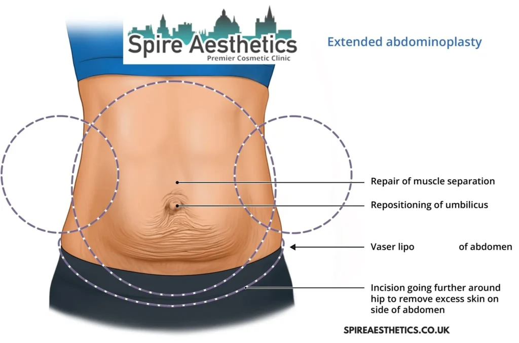 Understanding Loose Skin After Gastric Band Seacombe Surgery and HIFU Treatment