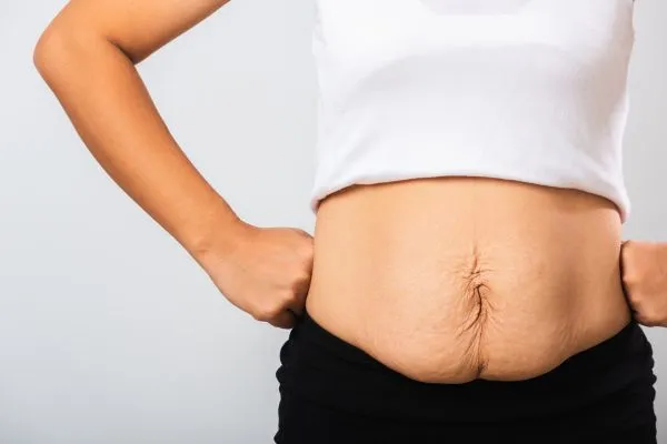 Image of a woman's stomach after weight loss with sagging skin following a gastric band Seacombe
