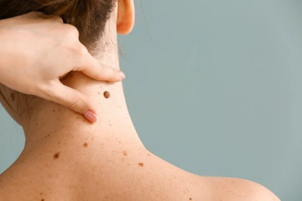 skin blemish removal Seacombe treatment